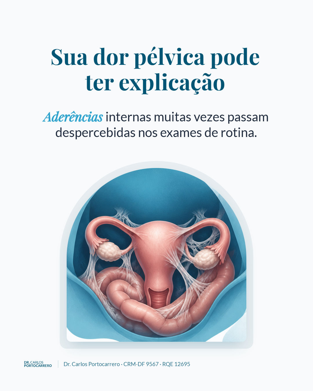 Capa: "Sua dor pélvica pode ter explicação", com a ilustração de órgãos da pelve unidos por aderências.